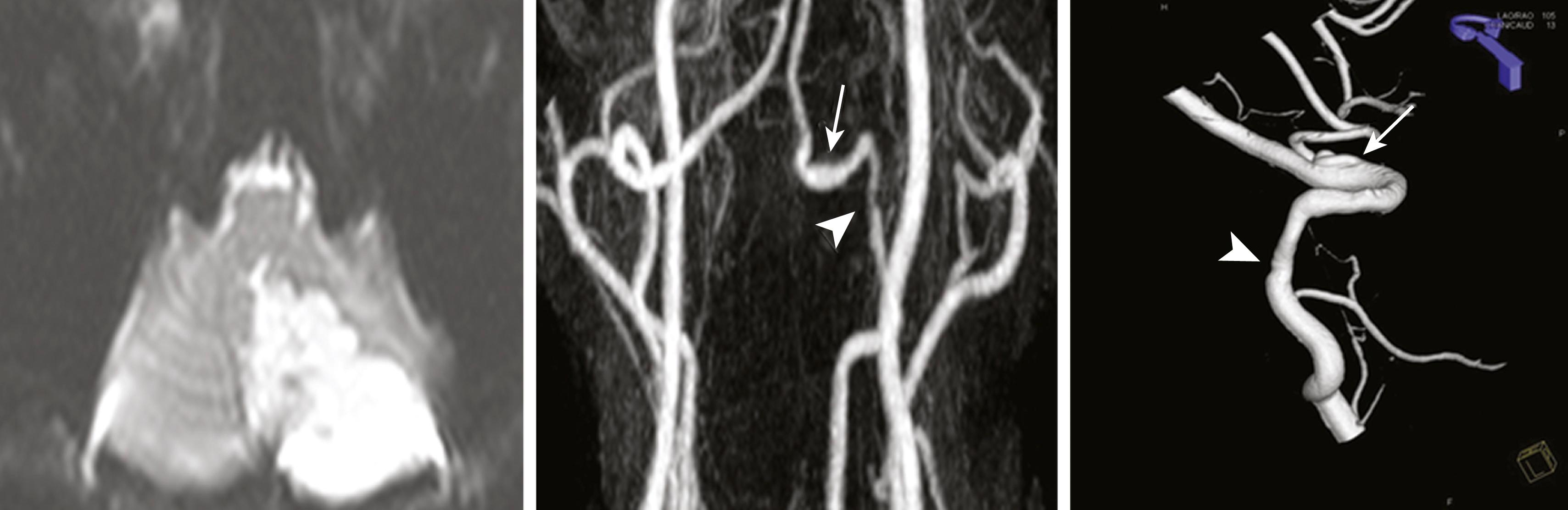 Fig. 26.11, A 33-year-old man without vascular risk factors suddenly developed right nuchal and occipital pain, which was followed by severe dizziness and vertigo. Diffusion-weighted MRI showed an infarct in the left medial posterior inferior cerebellar artery territory (left image) . MR angiogram showed stenosed distal vertebral artery (ar) and aneurysmal dilatation (arrow) , consistent with arterial dissection (middle image) . Three-dimensional reconstruction angiogram showed the vascular lesions more clearly (right image) .