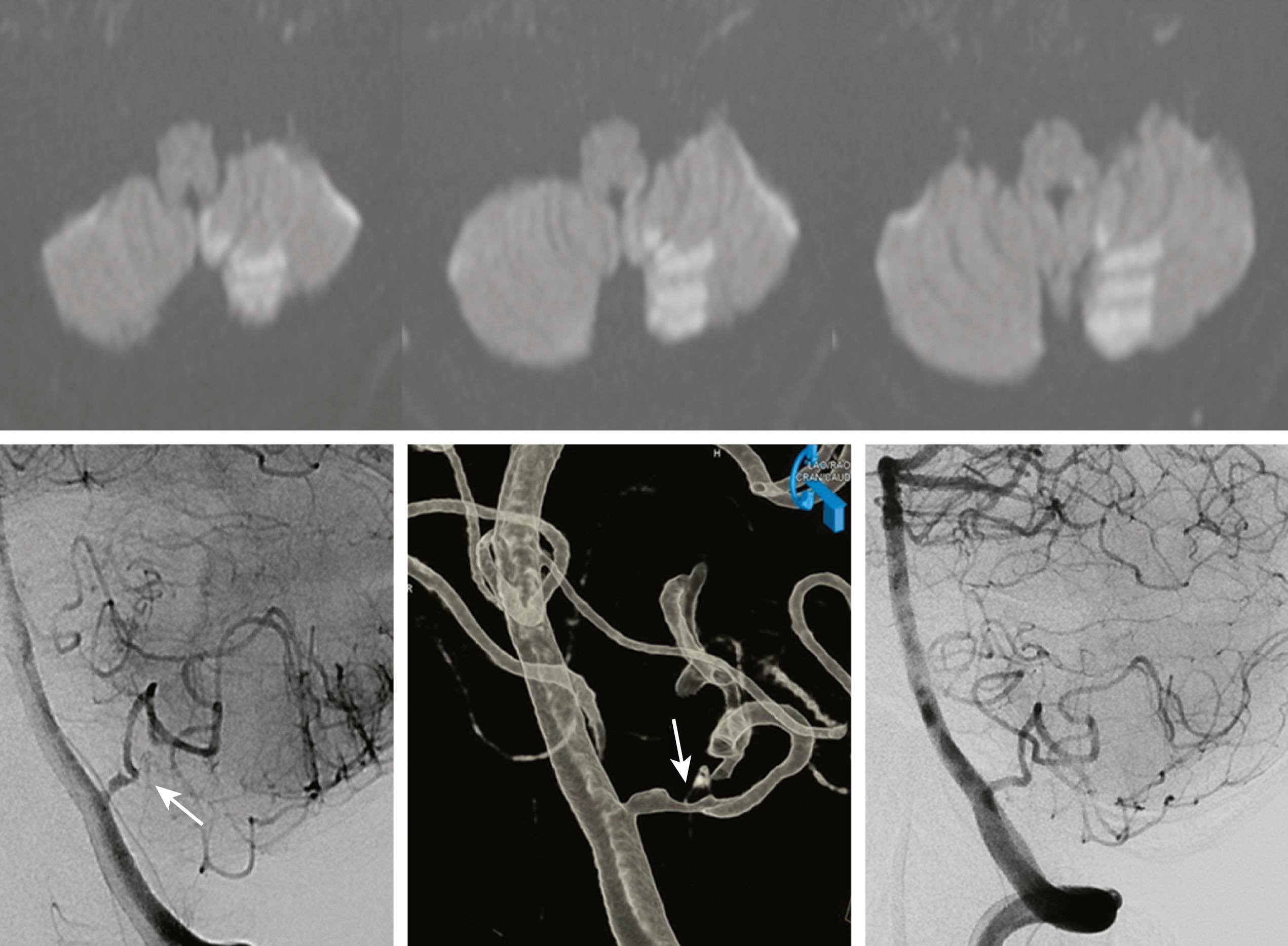 Fig. 26.12, A 53-year-old woman suddenly developed vertigo and gait instability. Neurologic examination showed gait ataxia, left trigeminal sensory deficit, and left Horner sign. Diffusion-weighted MRI showed left medial posterior inferior cerebellar artery (PICA) territory infarction involving the cerebellum and dorsal lateral medulla (upper images) . Angiogram showed dilatation and focal stenosis (arrow) in the proximal part of the PICA consistent with dissection (lower, left and middle images) . Repeat angiogram 1 month later showed that the vascular abnormality improved (lower right image) .