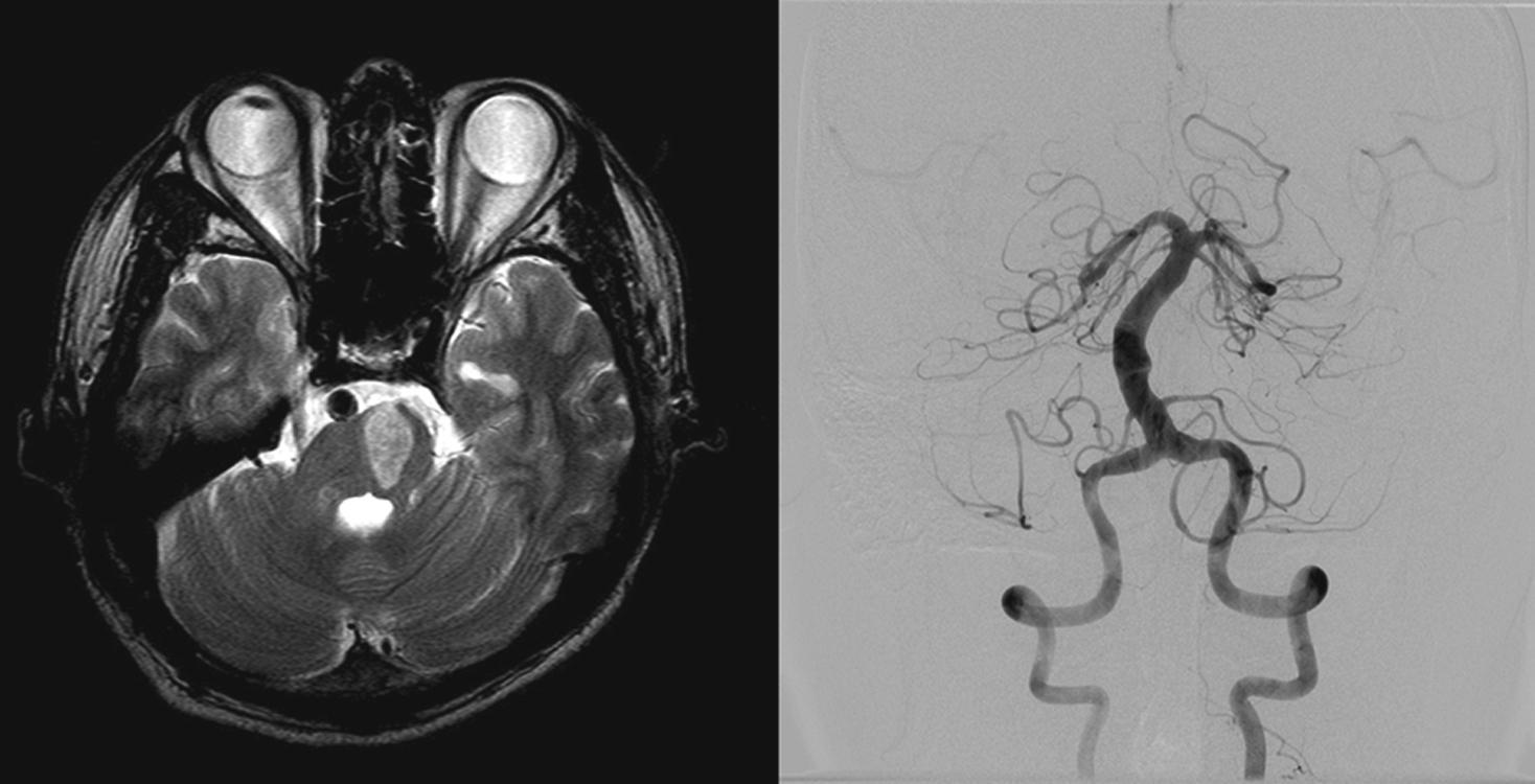 Fig. 26.13, A 37-year-old hypertensive man suddenly developed right hemiparesis and dysarthria. MRI showed a left pontine base infarction. MR angiogram showed dolichoectatic basilar artery.