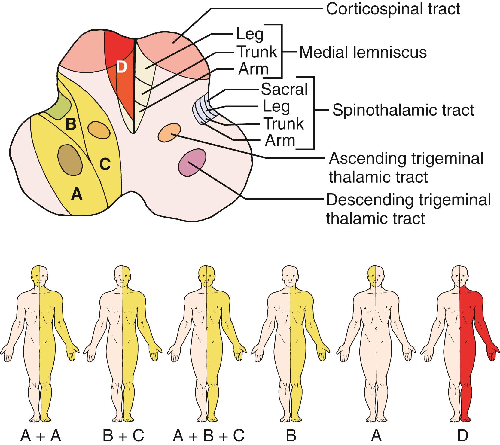 Fig. 26.14, Anatomic structures of the medulla and various patterns of sensory dysfunction caused by medullary infarction. Yellow areas represent patterns of lateral medullary infarcts and red area represents the pattern of medial medullary infarction (see text for details).