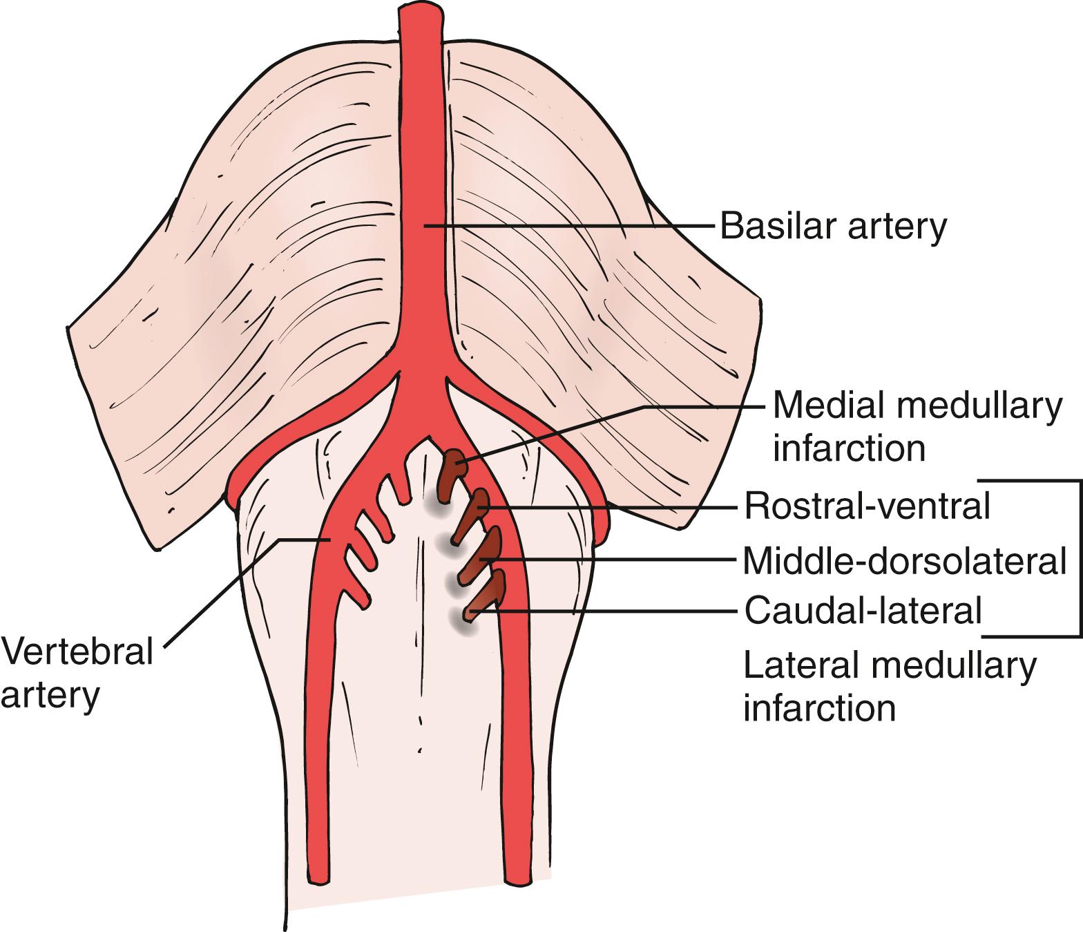 Fig. 26.15, Schematic drawing indicating pathogenesis of various patterns of lateral medullary infarction and medial medullary infarction due to intracranial vertebral artery disease.