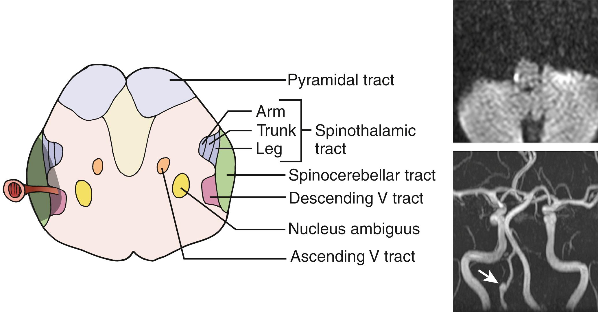 Fig. 26.16, Schematic drawing showing important structures in the lower medulla and explaining caudal-lateral type of lateral medullary infarction (left image) . Diffusion-weighted MRI shows a right caudal-lateral type lateral medullary infarction (right upper image) . This 46-year-old man had vertigo, headache, severe gait instability, Horner sign, and right periorbital pain. Sensory deficits were detected below T4 level on the left side. He did not have dysphagia or dysarthria. The infarct was caused by right distal vertebral artery dissection (arrow, right lower image) .