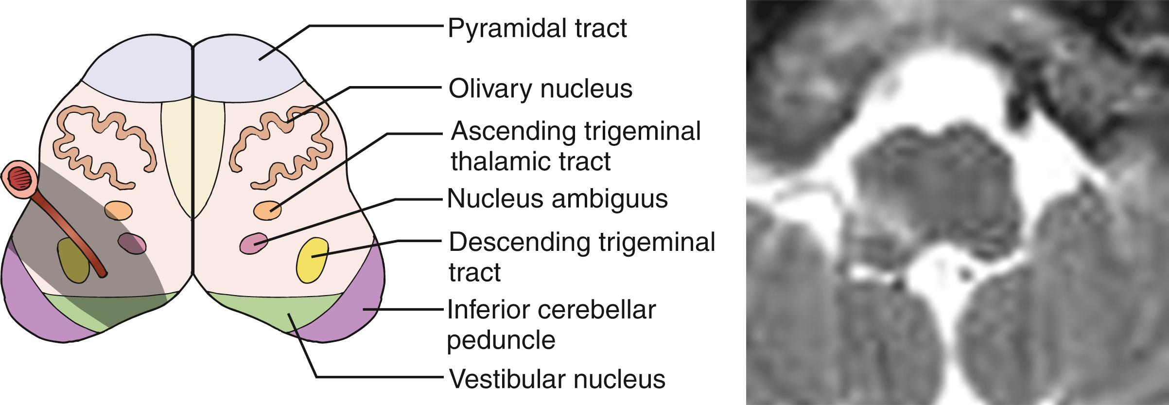 Fig. 26.17, Schematic drawing showing important structures in the medulla and explaining middle-dorsolateral type of lateral medullary infarction (left image) . MRI shows a right middle-dorsolateral type of lateral medullary infarction (right image) . The patient had vertigo, gait ataxia, Horner sign, and moderate degree of dysphagia, dysarthria, and hoarseness. Sensory deficits were found in the right trigeminal area and left limbs and trunk.