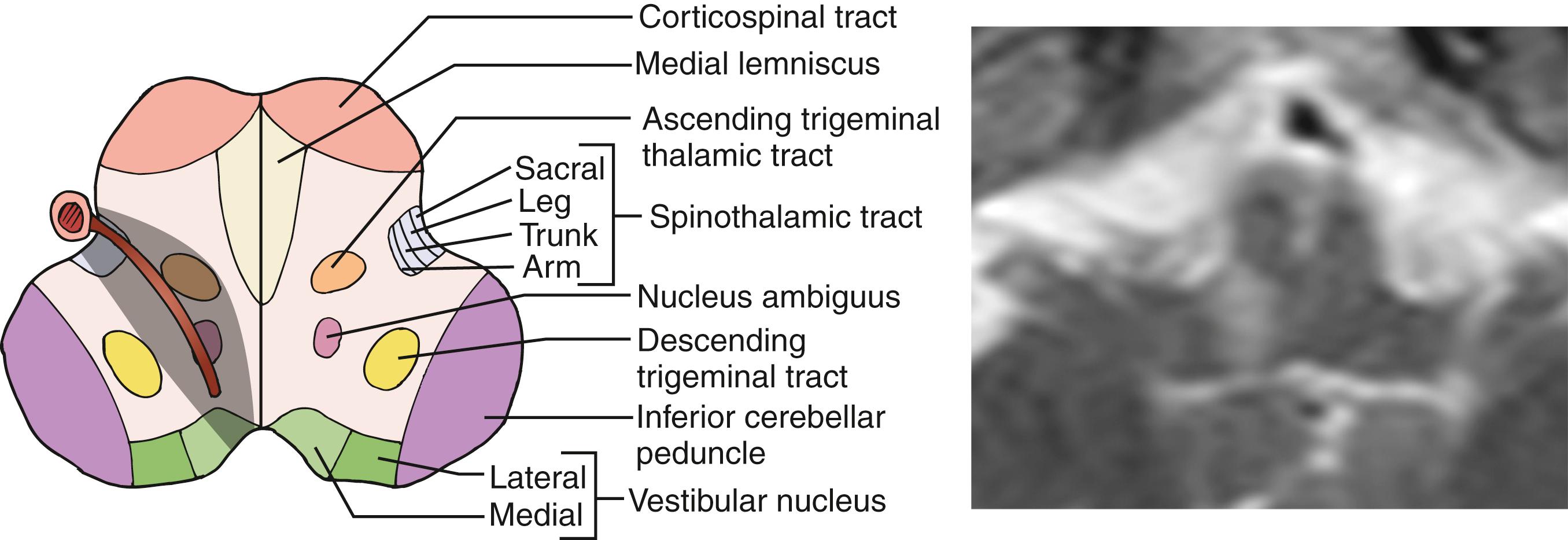 Fig. 26.18, Schematic drawing showing important structures in the medulla and explaining rostral-ventral type of lateral medullary infarction (left image) . MRI shows a right rostral-ventral type of lateral medullary infarction (right image) . The patient had severe dysarthria, hoarseness, and dysphagia and required a nasogastric tube for feeding. He had mild dizziness, transient gait ataxia, and partial Horner sign. Sensory deficit was detected in the left right trigeminal area and left limbs and trunk.