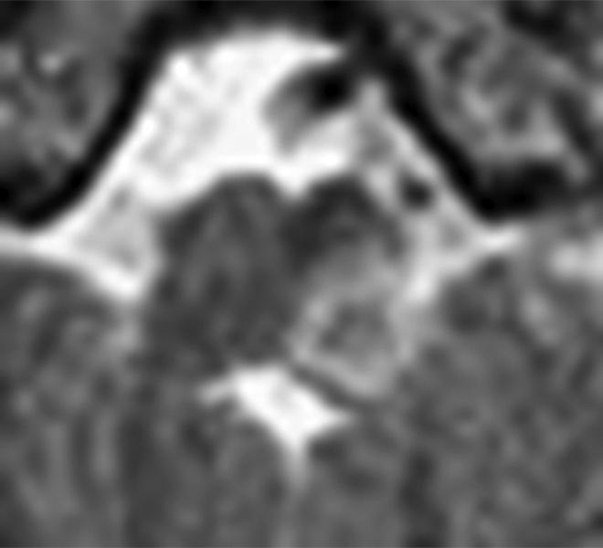 Fig. 26.19, An example of large infarction encompassing both the dorsal and ventral part of the lateral medulla that produces sensory disturbances in bilateral trigeminal areas and left limbs and trunk.