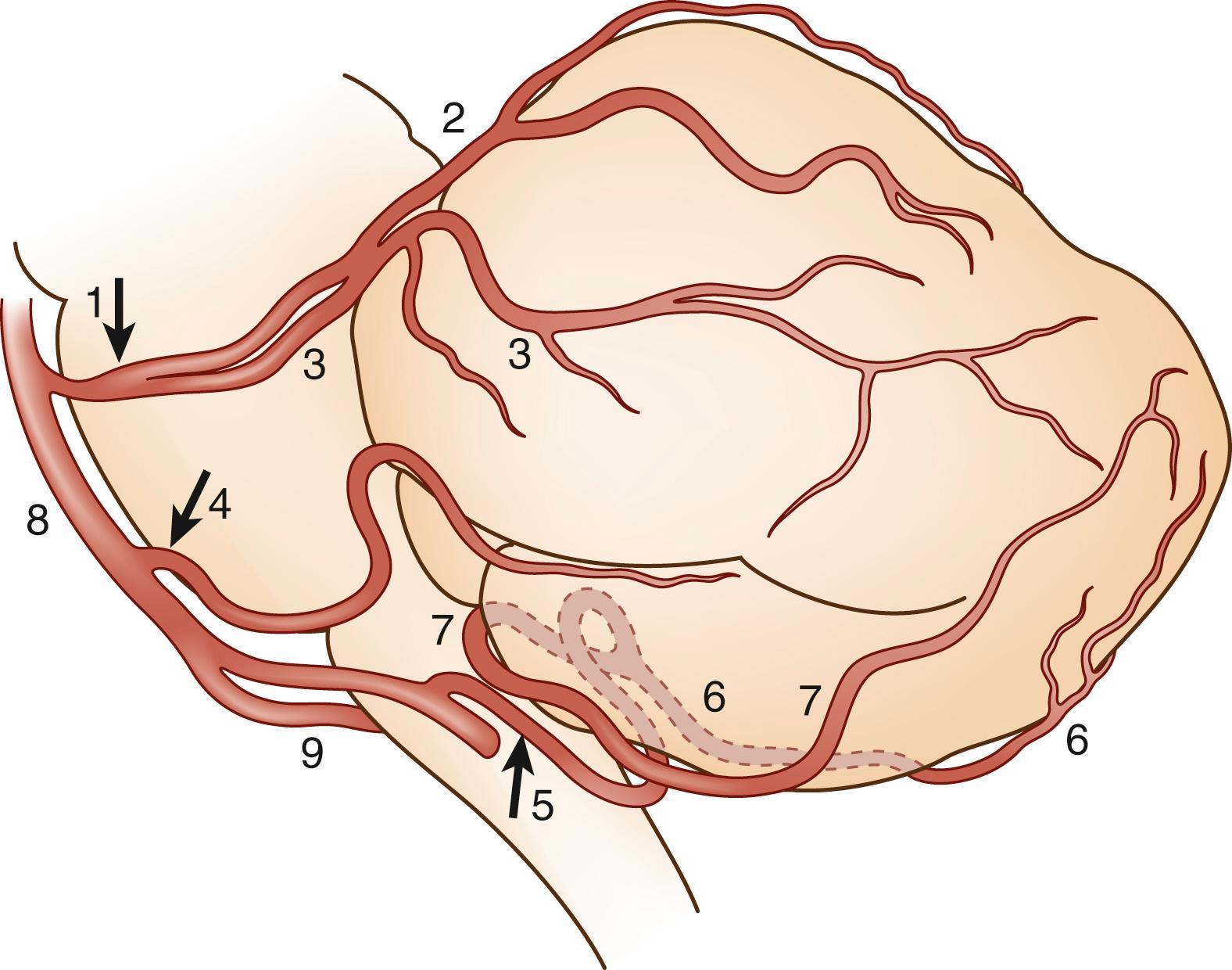 Fig. 26.3, Lateral view of cerebellar arteries. 1 , Superior cerebellar artery (SCA); 2 , medial branch of the SCA; 3 , lateral branch of the SCA; 4 , anterior inferior cerebellar artery; 5 , posterior inferior cerebellar artery (PICA); 6 , medial branch of the PICA; 7 , lateral branch of the PICA; 8 , basilar artery; 9 , vertebral artery. Arrows indicate main arteries directly arising from vertebro-basilar arteries.