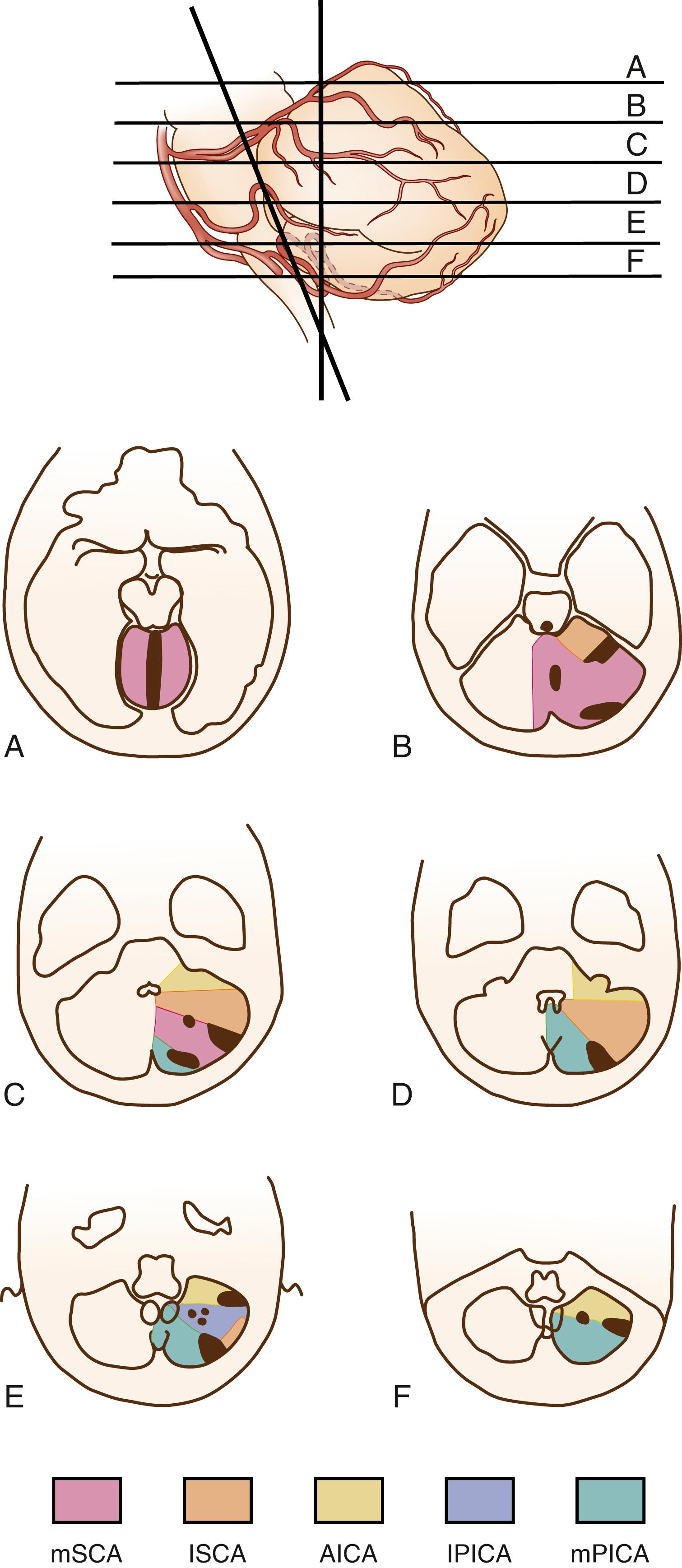 Fig. 26.4, Anatomic drawings (A–F) of the territory of branches of the cerebellar arteries as they appear on computed tomography and magnetic resonance imaging. AICA , Anterior inferior cerebellar artery; lPICA, lateral branch of the posterior inferior cerebellar artery; lSCA , lateral branch of the SCA; mPICA , medial branch of the PICA; mSCA , medial branch of the superior cerebellar artery.