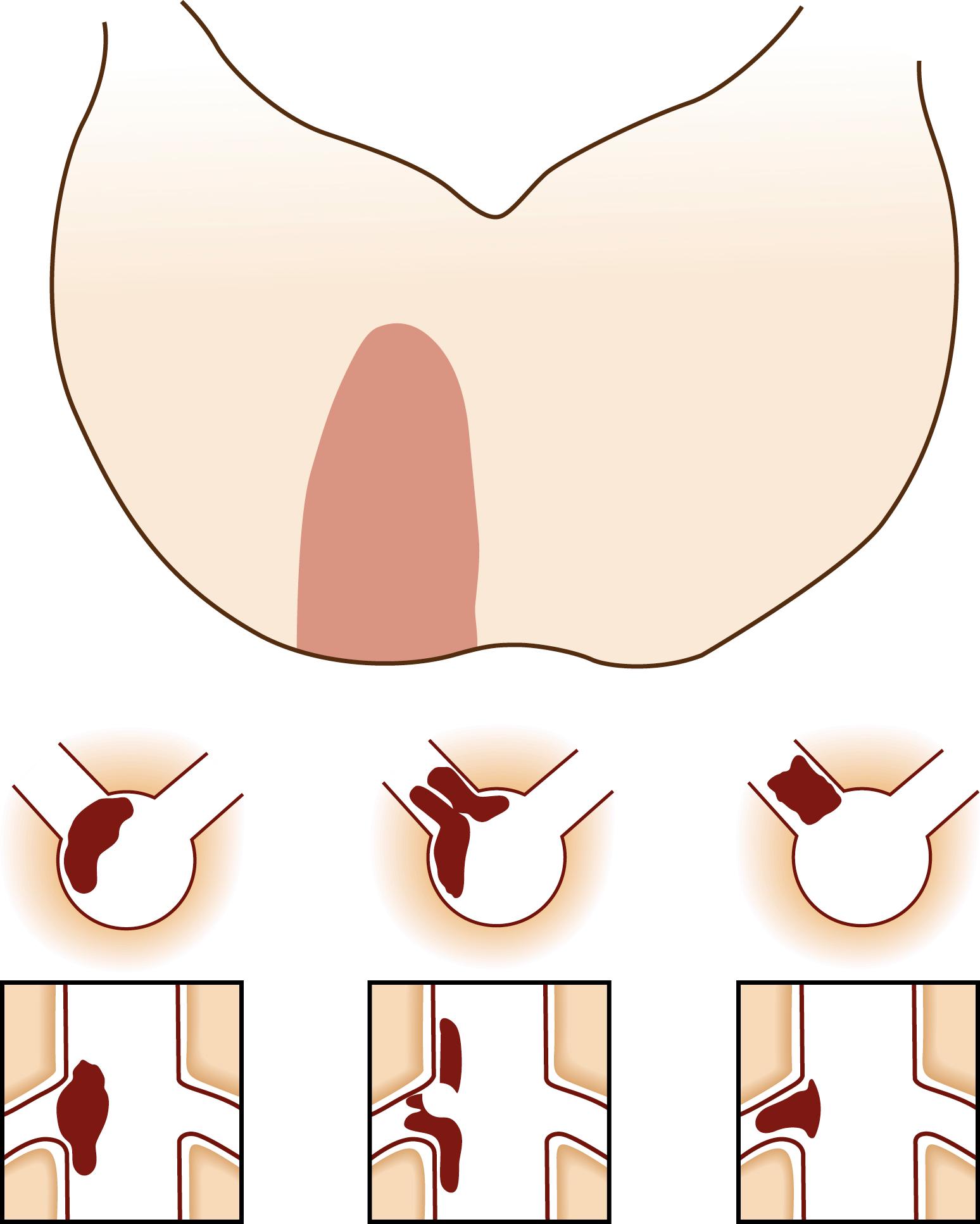 Fig. 26.6, The frequent location of atherosclerosis in the posterior circulation. Atherosclerosis in proximal vertebral arteries is not depicted.