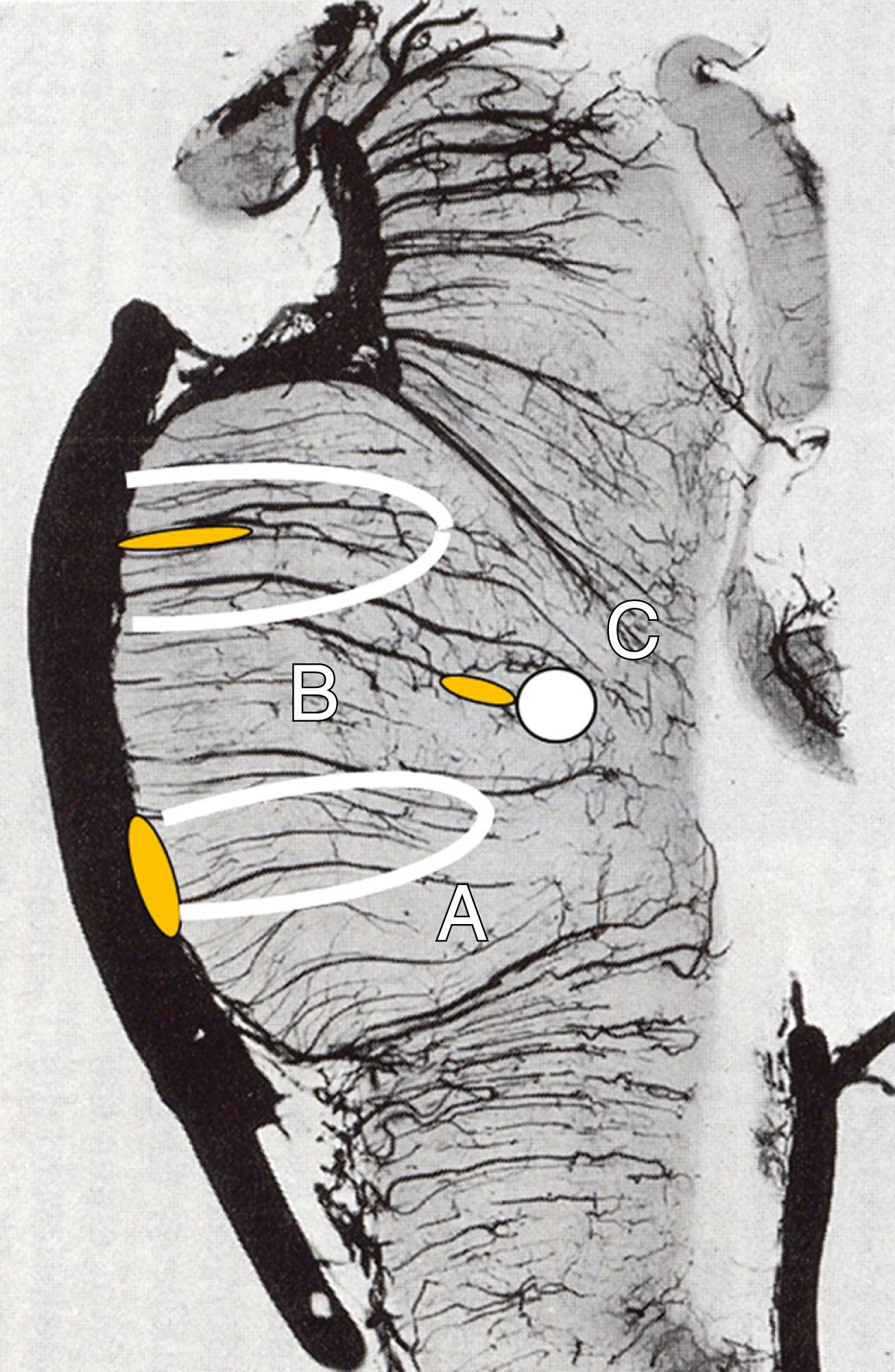 Fig. 26.7, Schematic drawing of the mechanism of brainstem infarction. A, Atherothrombosis occurring in the basilar artery obliterates the orifice of the perforator. B, Atherosclerotic occlusion of the proximal portion of the perforator. C, lipohyalinotic distal small artery occlusion. A and B are referred to as “branch atheromatous disease.” They produce infarcts abutting on the basal surface, whereas C (lypohyalinotic disease) produces an island-like deep infarction.