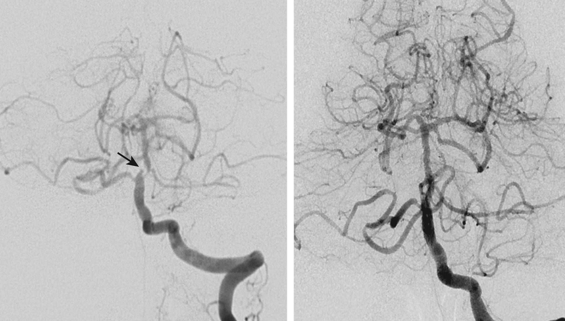 Fig. 26.8, An example of recurrent vertebrobasilar artery territory transient ischemic attacks attributed to hypoperfusion. Left image; A 68–year-old woman with hypertension, diabetes, and a history of coronary heart disease developed recurrent, brief attacks of dizziness, diplopia, dysarthria, and gait instability that lasted for seconds or a few minutes. The episodes more often occurred when patient was working and exhausted. MRI showed no abnormal findings. Angiogram showed severe stenosis of the basilar artery just above the right anterior inferior cerebellar artery and below the left anterior cerebellar artery (arrow) . Right image; Angioplasty and stenting were performed and the stenosis was improved. The patient no longer developed such symptoms during 6 months of follow up.