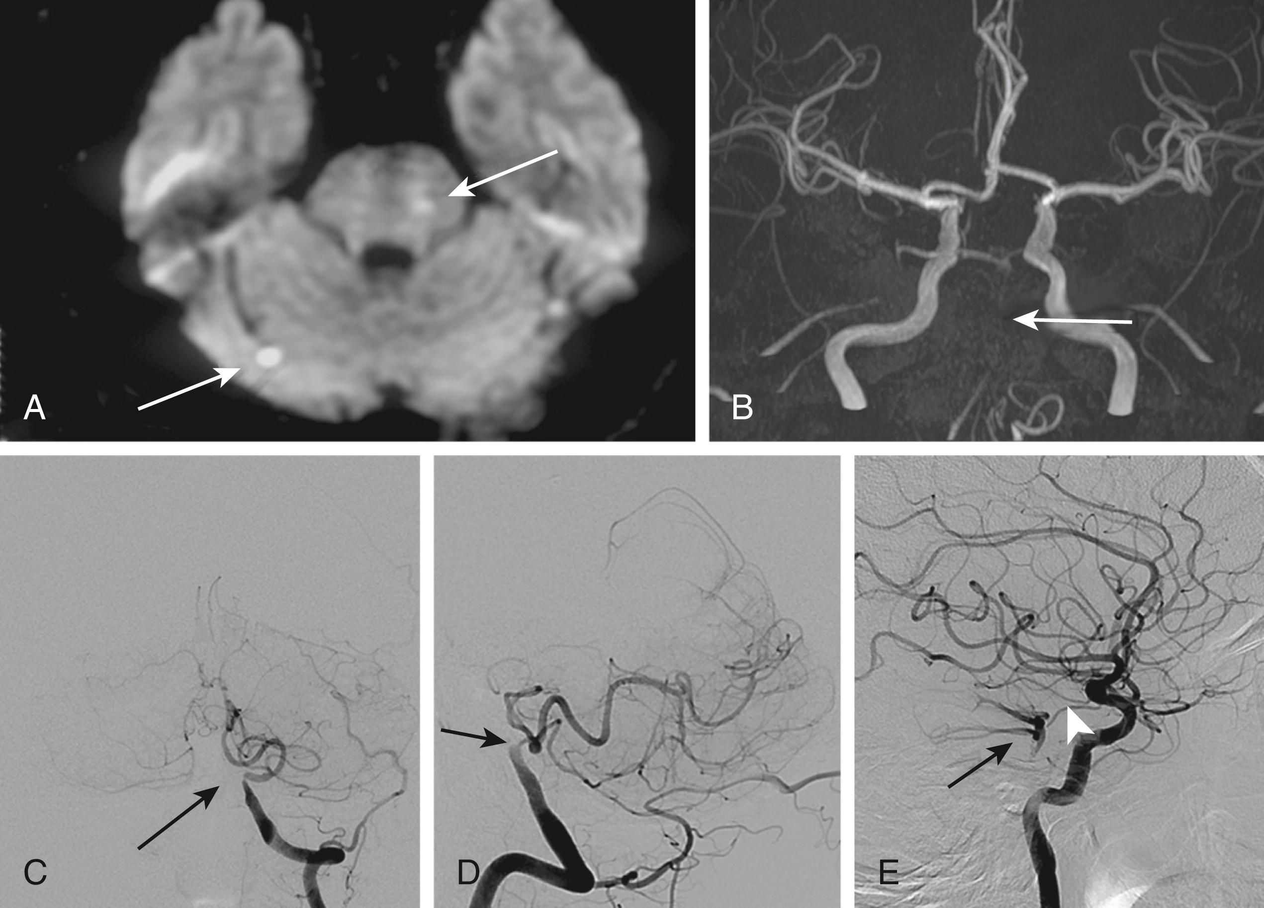 Fig. 26.9, An example of a patient with basilar artery occlusion with benign outcome. A 66-year-old man with hypertension and diabetes mellitus developed sudden dizziness and dysarthria that lasted for 10 minutes. Neurologic examination showed no abnormal signs. Diffusion-weighted MRI shows two small recent infarcts in the left pons and right cerebellum (A, arrows ). MR angiogram shows nonvisualization of the basilar artery due to thrombotic occlusion (B, arrow ). Conventional angiogram 4 days later shows occlusion of the vertebrobasilar junction on both sides. Anteroposterior view (C) and lateral view (D) show occlusion of the distal left vertebral artery (arrows) . The left posterior inferior cerebellar artery is well developed to supply much of the left cerebellum. Right cerebellum is also supplied by vermian branches from left posterior inferior cerebellar artery. Lateral view of the carotid system shows that an upper portion of the posterior circulation system (posterior cerebral artery, superior cerebellar artery, and upper portion of the basilar artery) (E, arrow ) is supplied by posterior communicating artery (ar) .