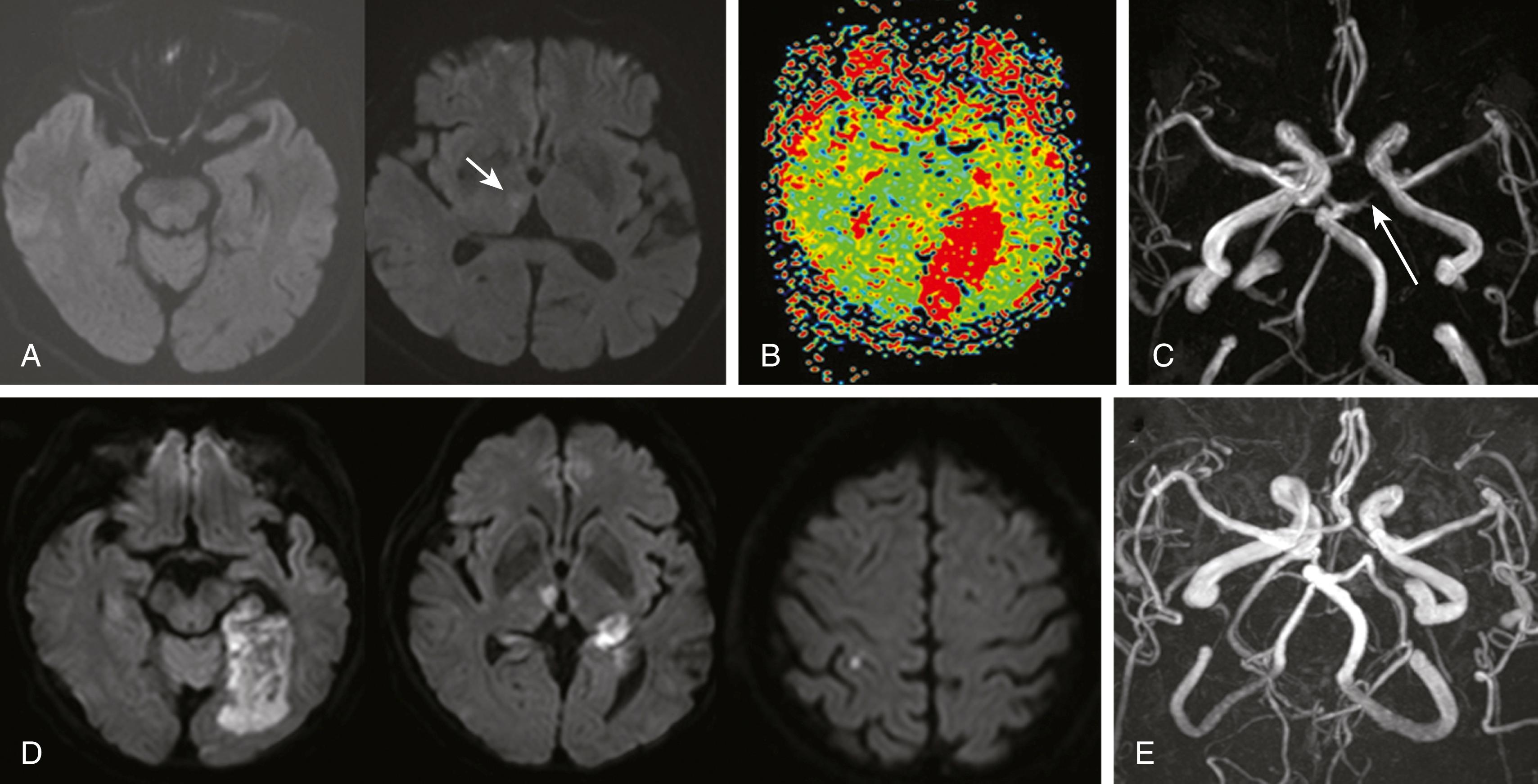 Fig. 26.10, A 71-year-old woman with atrial fibrillation suddenly developed confusion. (A) Initial diffusion-weighted MRI (DWI) showed right medial thalamic infarction (short arrow) without definite lesion on the occipital area. (B) Perfusion-weighted MRI (mean transit time map) showed decreased perfusion in the left occipital area. (C) MR angiography showed occlusion of the left posterior cerebral artery (long arrow). (D) Follow-up DWI 4 days later showed hemorrhagic infarction in the left occipital area, and an infarct in the right thalamus. A small infarct is also shown in the right cortical area of middle cerebral artery territory. (E) MR angiography showed complete recanalization of the posterior cerebral artery.