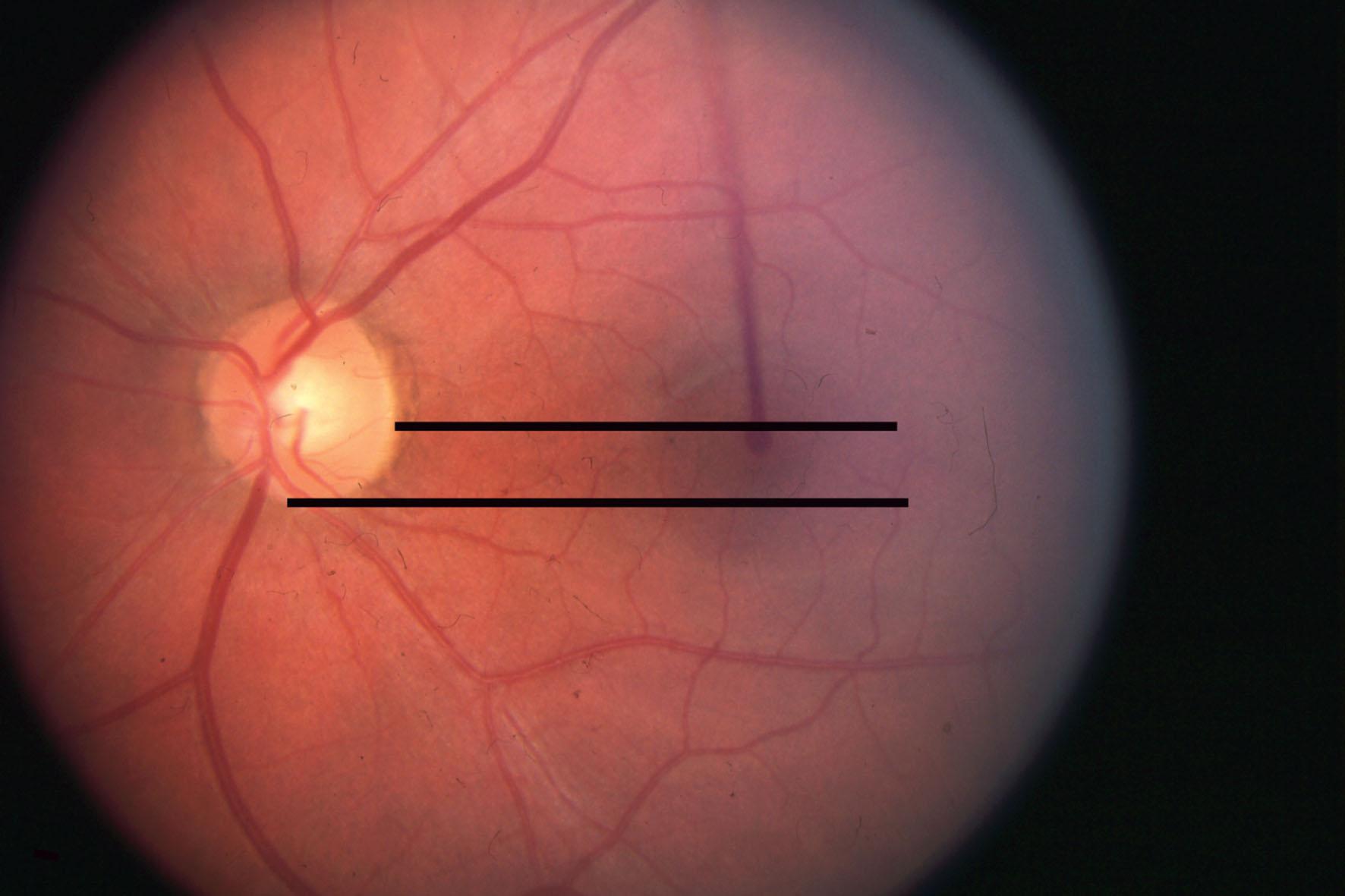 Fig. 82.2, Normal relationship of fovea to disc with respect to torsion. The fovea is normally positioned level with the lower third of the optic disc. The borders of normal lie between the two black lines in the figure. This photograph indicates an absence of objective torsion but is near the border for intorsion.
