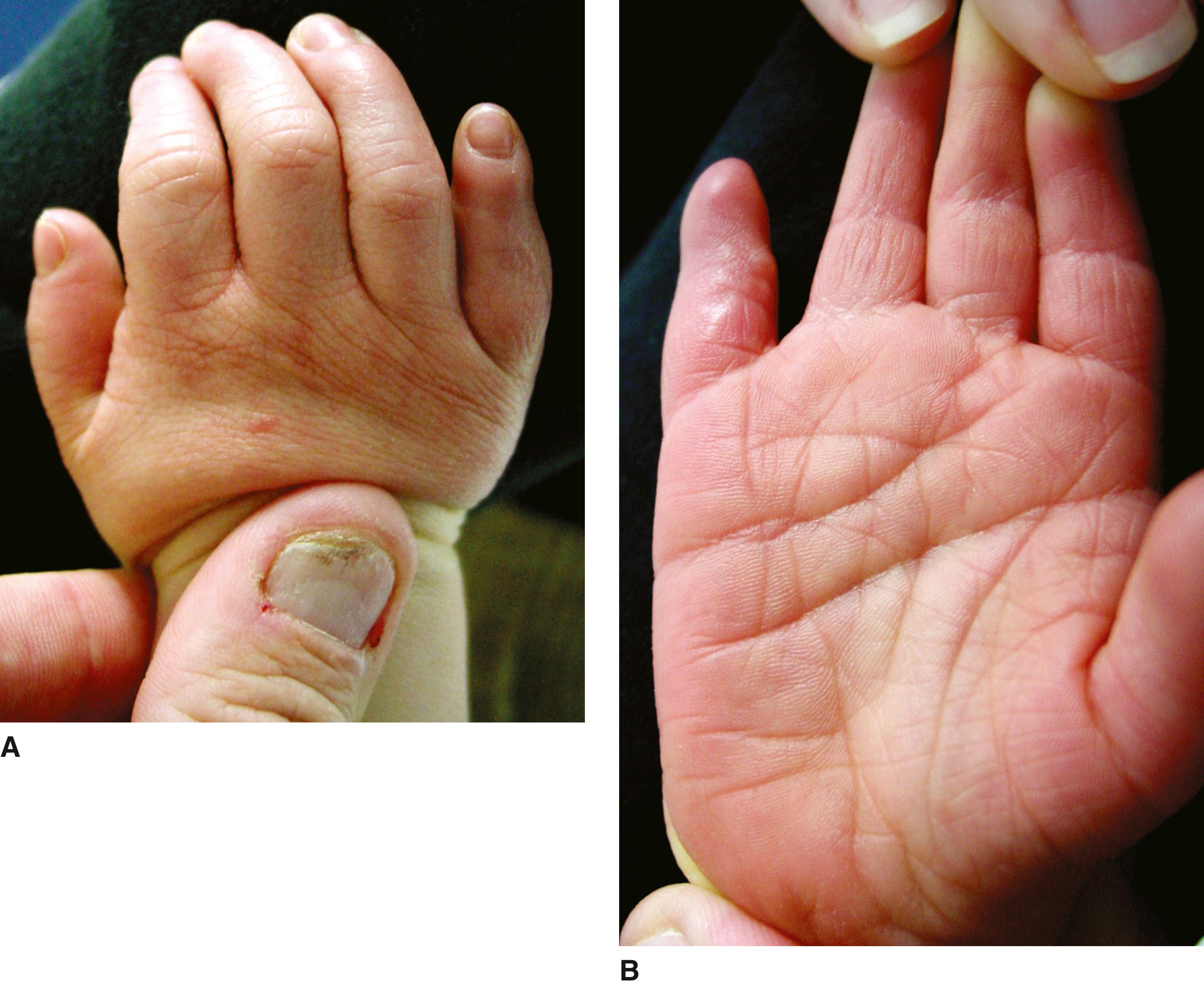 FIGURE 2, A and B, Note the fifth finger clinodactyly and proximal implantation of the thumb.