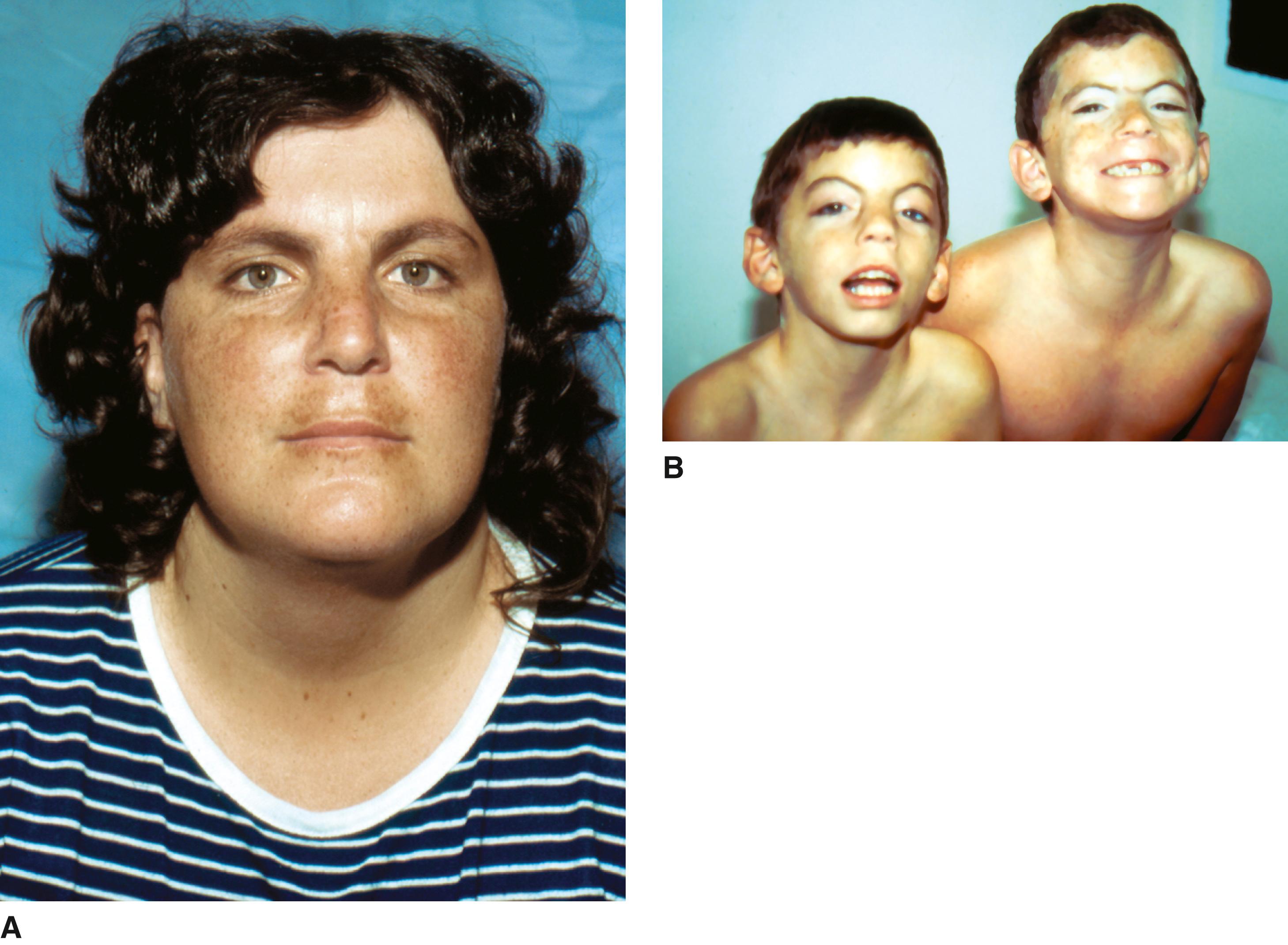 FIGURE 3, A and B, Mildly affected mother and her severely affected sons.