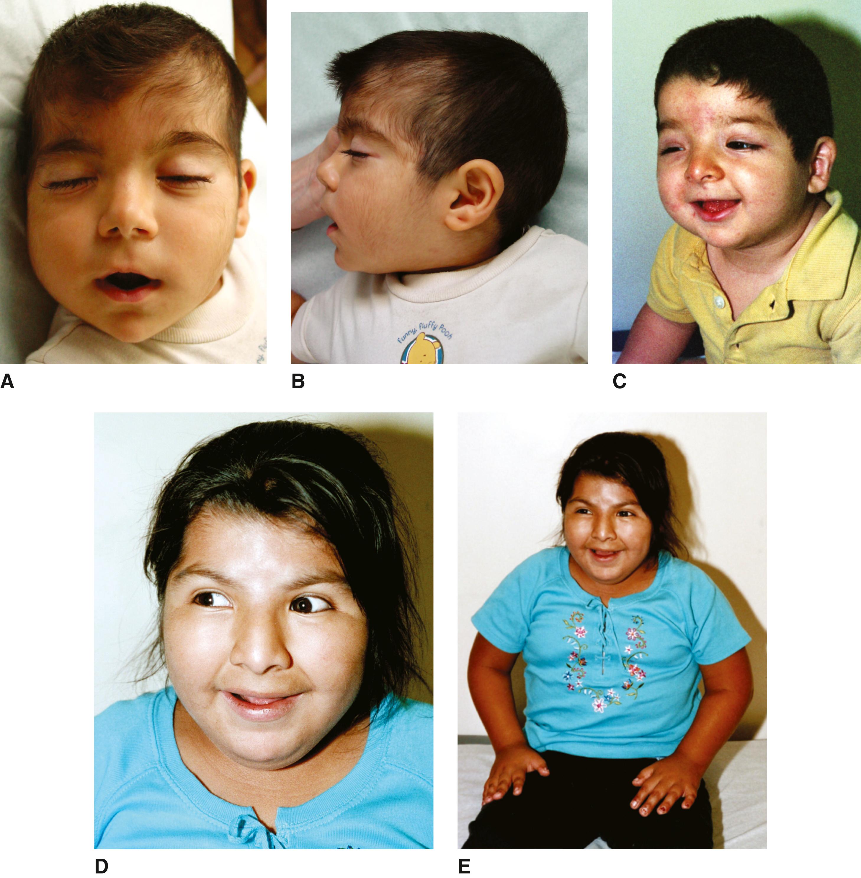 FIGURE 1, Young infant ( A and B ); 21-month-old child (C) ; and 10-year-old child ( D and E ) with Rubinstein-Taybi syndrome. Note the hirsutism, downslanting palpebral fissures, maxillary hypoplasia, prominent nose with nasal septum extending below alae nasi, and low, posteriorly rotated ears.