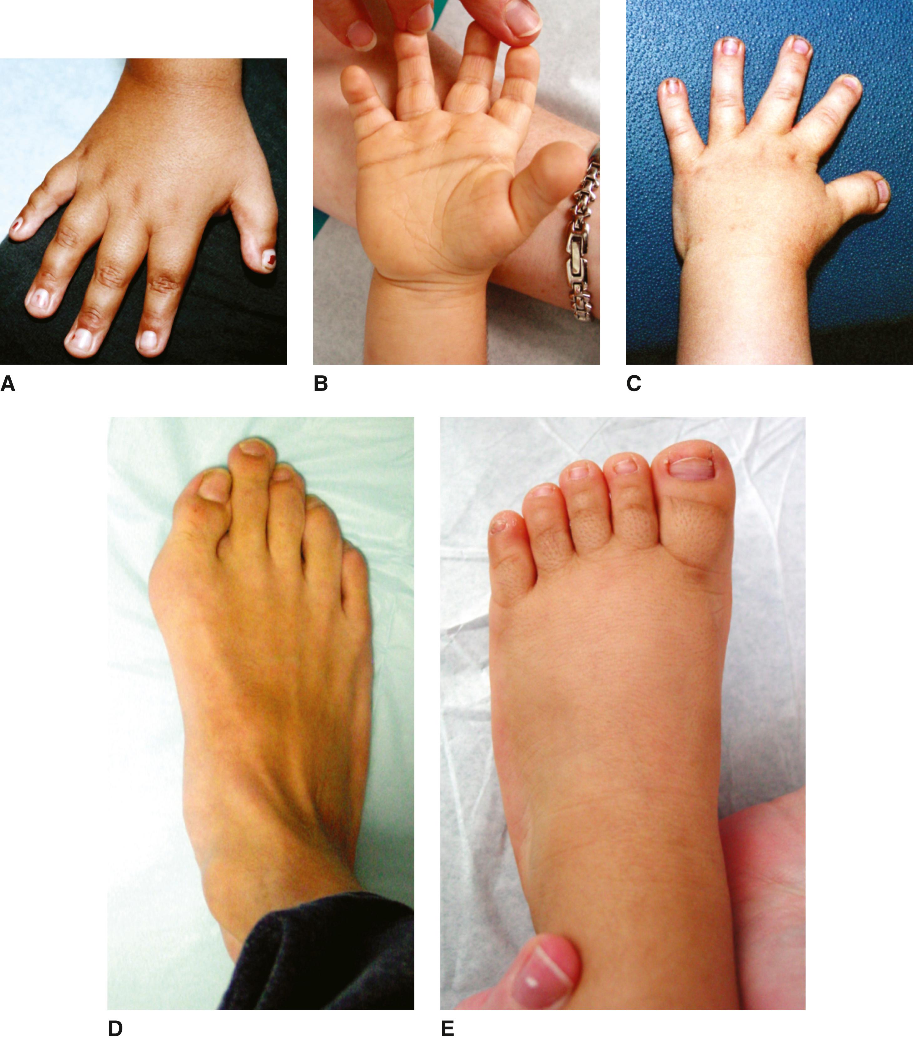 FIGURE 2, A–C, Broad thumbs with radial angulation and persistent fingertip pads. D and E, Broad great toes.