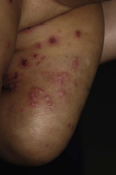 Figure 10.1, Papules, pustules, and crusted erosions in a 9-month-old infant with S. aureus infection.