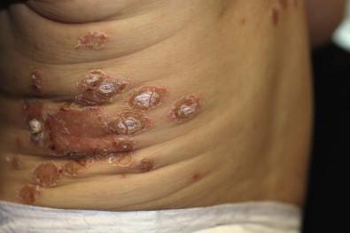 Figure 10.3, Staphylococcal impetigo in this 9-month-old infant with features of exotoxin-producing S. aureus , including collarettes of scale, larger areas involvement and shellac-like superficial scale.