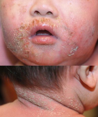 Figure 10.4, Staphylococcal scalded skin syndrome in a young infant.