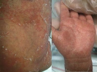 Figure 10.6, Congenital candidiasis in a 5-day-old infant.