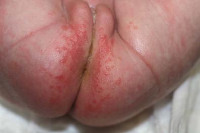 Figure 10.7, Acquired Candida albicans diaper rash in a 3-week-old infant.