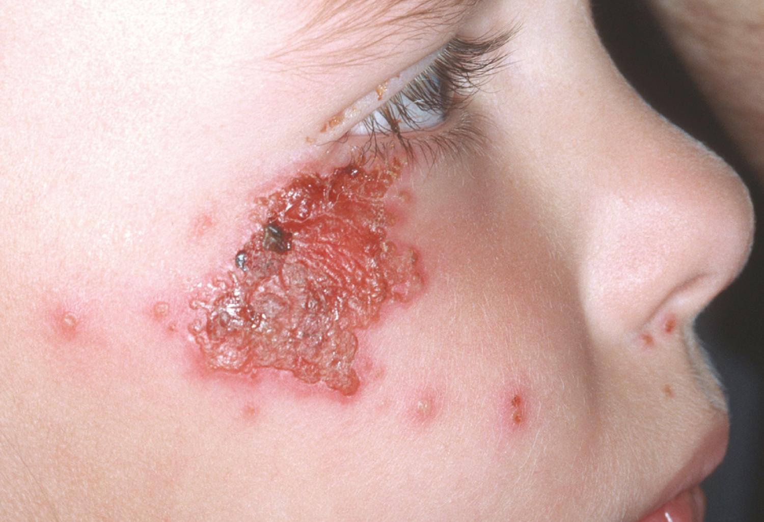 FIGURE 69.2, A young girl hospitalized for febrile pneumonia had reactivation of herpes simplex virus 1 in a dermatomal distribution on her face.