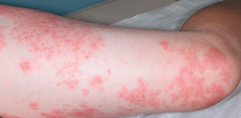 FIGURE 69.3, Typical appearance of zoster on the thigh of an adolescent.