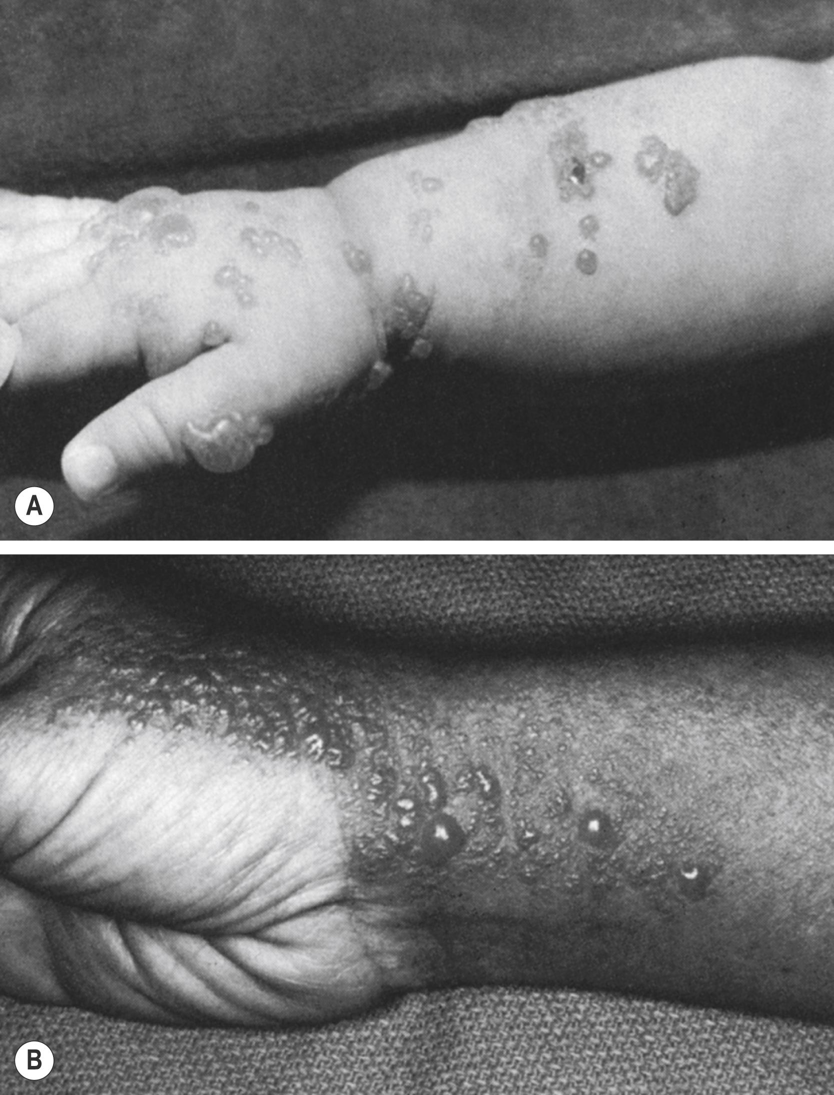 FIGURE 69.4, (A) Coalesced vesicles and bullae on the dorsal hand and forearm of an infant with zoster without superinfection. (B) Vesicles and bullae on the hand and wrist of a girl with contact dermatitis due to poison oak.