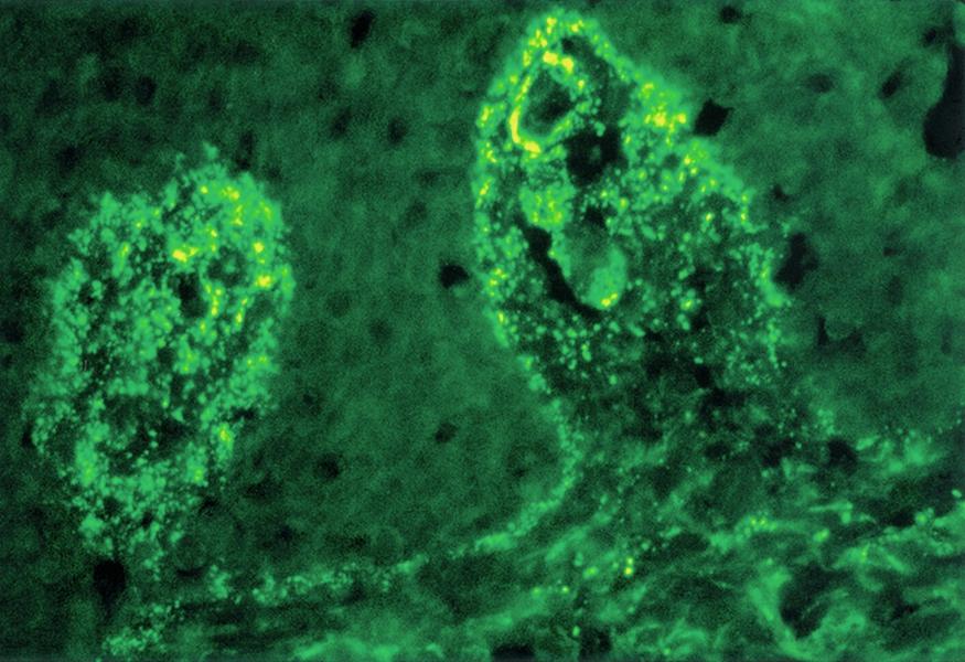 Fig. 10.2, Direct immunofluorescence of skin demonstrating linear granular immunoglobulin A along the basement membrane zone and in the papillary dermis in a patient with dermatitis herpetiformis.