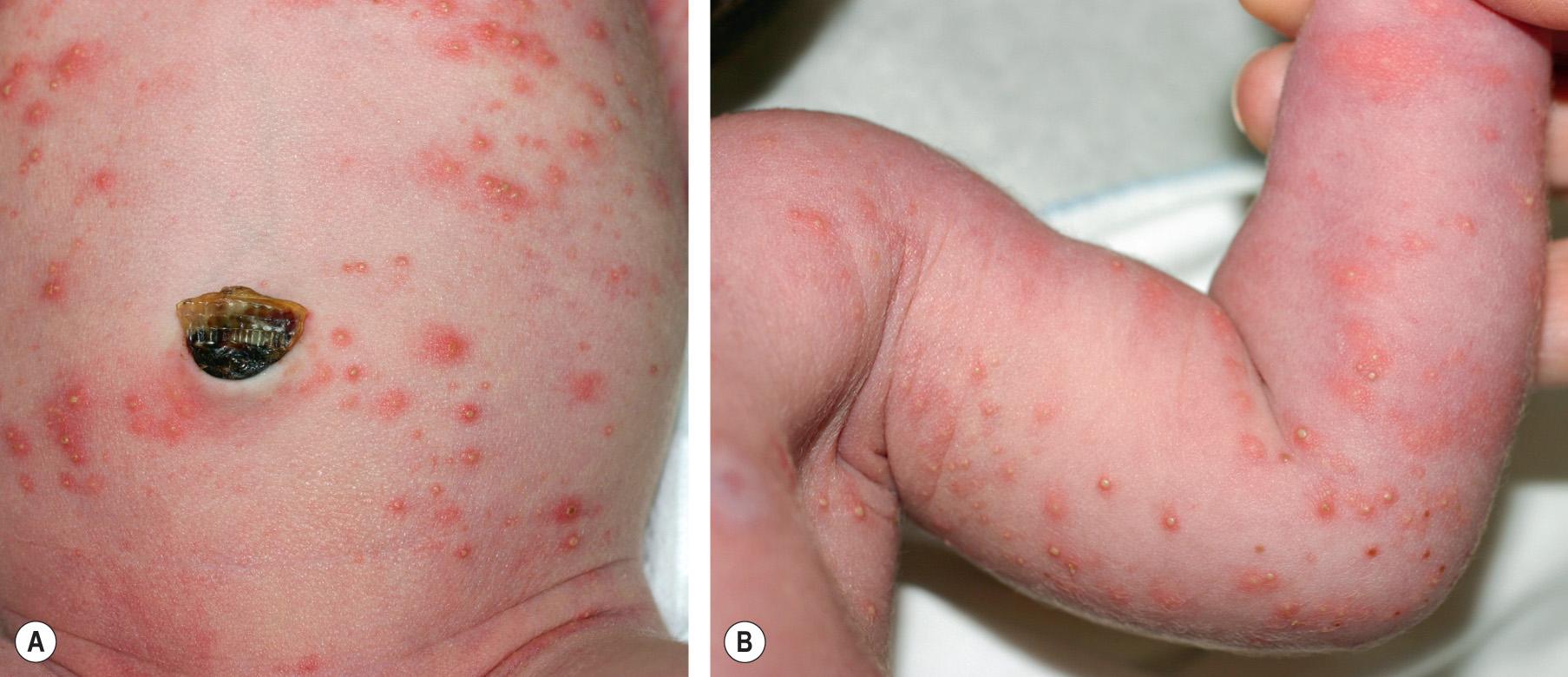 Fig. 34.2, Erythema toxicum neonatorum.