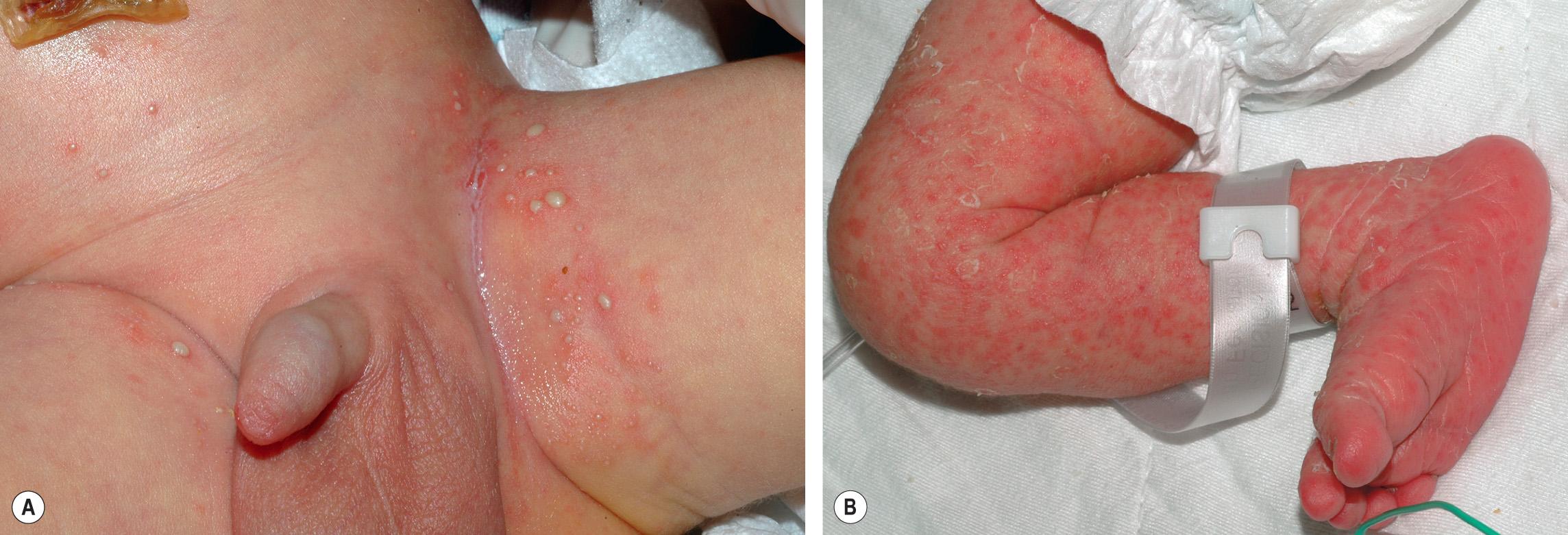 Fig. 34.3, Staphylococcal infection versus congenital candidiasis.