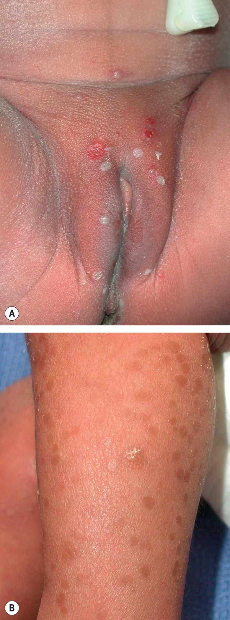 Fig. 34.4, Transient neonatal pustular melanosis in an African-American neonate.