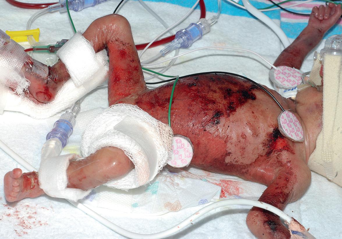 Fig. 34.7, Congenital candidiasis in a neonate born at 24 weeks' gestation.