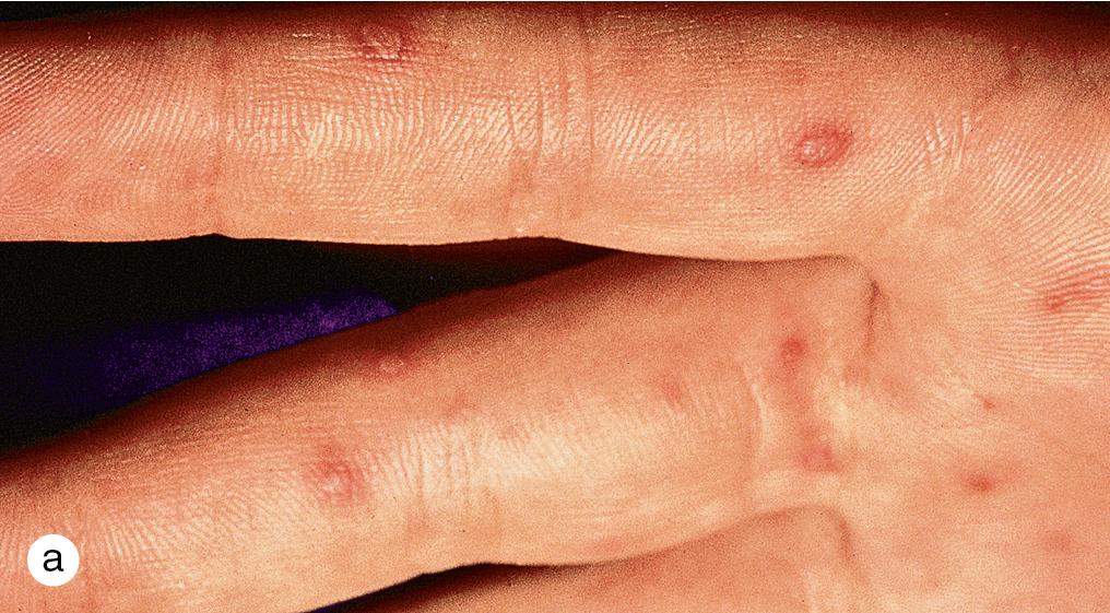 Fig. 4.10, Hand-foot-and-mouth disease. Characteristic elongated vesicles on a red base are shown on (a) the palmar surface of the fingers and (b) the plantar surface of the foot of children with Coxsackie hand-foot-and-mouth disease. (c) The enanthema, consisting of shallow yellow ulcers surrounded by red halos, which may be found on the labial or buccal mucosa, tongue, soft palate, uvula, and anterior tonsillar pillars. When the enanthema occurs in the absence of a rash, the disorder is known as herpangina.