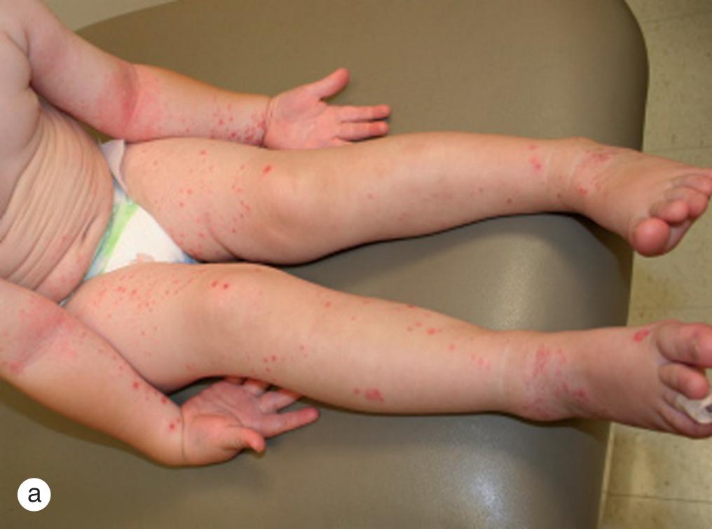 Fig. 4.11, Coxsackie A6 virus infection. A 2-year-old boy developed high fever and widely disseminated vesicles and crusts concentrated on the (a) arms, on the (a,b) legs, and around the (c) mouth. He had erosions on his palate and, on careful observation, lancet-shaped vesicles on a red base on his hands and (d) feet. The blisters began to dry in 2 days and resolved within 5 days without treatment.