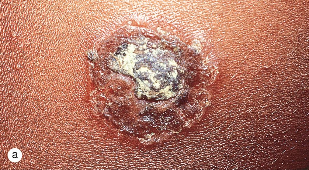 Fig. 4.12, Bullous impetigo. (a) A large doughnut-shaped blister with a central crust and smaller satellite lesions suggests the diagnosis of bullous impetigo. (b) Widespread blisters in this toddler responded quickly to oral cefalexin. (c) Painful impetiginized pustules obscured the primary diagnosis of scabies in this teenager. A careful examination, however, revealed burrows on her palms and soles, and she was treated with oral cefalexin and topical 5% permethrin cream. (d) A healthy adolescent with an irritant dermatitis from shaving developed expanding confluent crusted papules typical of secondary impetiginization from Staphylococcus aureus . (e) A 5-year-old girl who was recovering from varicella developed several confluent erosions with an expanding bulla at the periphery and central crusting.