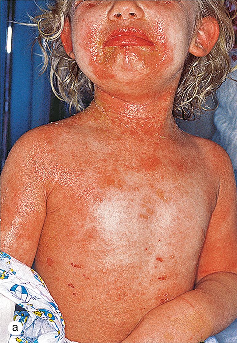 Fig. 4.13, Staphylococcal scalded-skin syndrome. (a) A healthy 3-year-old boy developed fever, periorificial periarticular crusting, and generalized, tender red skin. Nikolsky sign was present, and Staphylococcus aureus was cultured from the crust around the eyes. (b) Note the Nikolsky sign in the axilla as evidenced by superficial sloughing of the skin from movement of the arm.