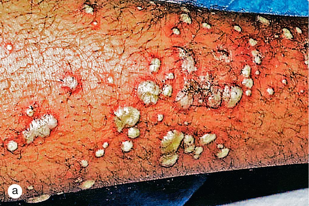 Fig. 4.14, (a) Staphylococcal folliculitis recurred chronically on the extremities of a healthy adolescent. He cleared with anti-staphylococcal antibiotics, and preventative antibiotics helped somewhat. (b) A 4-year-old boy developed recurrent pustules and deep-seated boils on his extremities. A bacterial culture revealed methicillin-resistant Staphylococcus aureus sensitive to clindamycin.