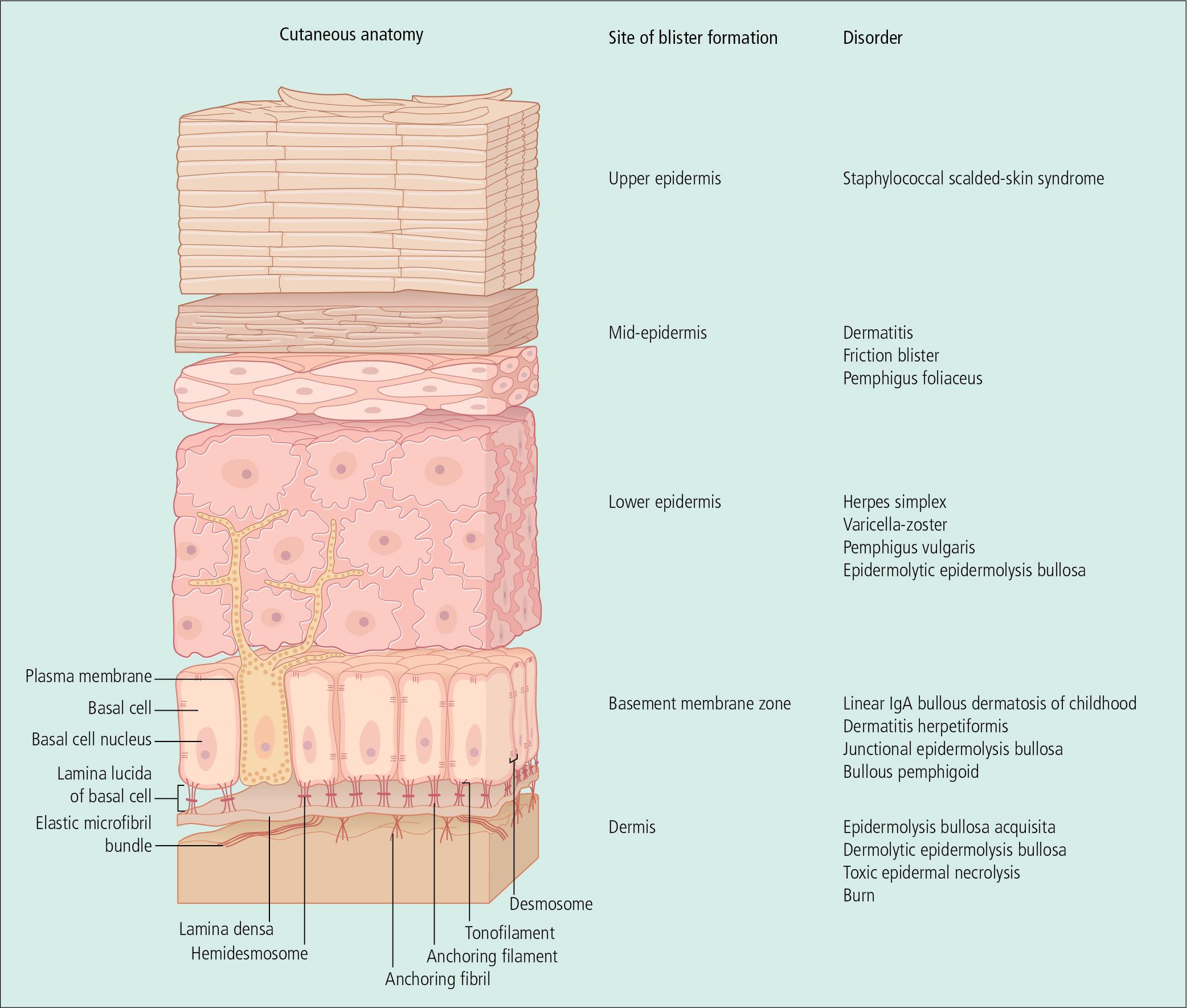 Fig. 4.1, Anatomy of vesiculopustular dermatoses.