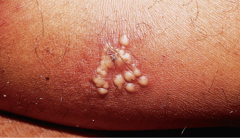 Fig. 4.4, Clustered pustules appeared on the posterior thigh of a teenager with recurrent herpes simplex type 2 infection.