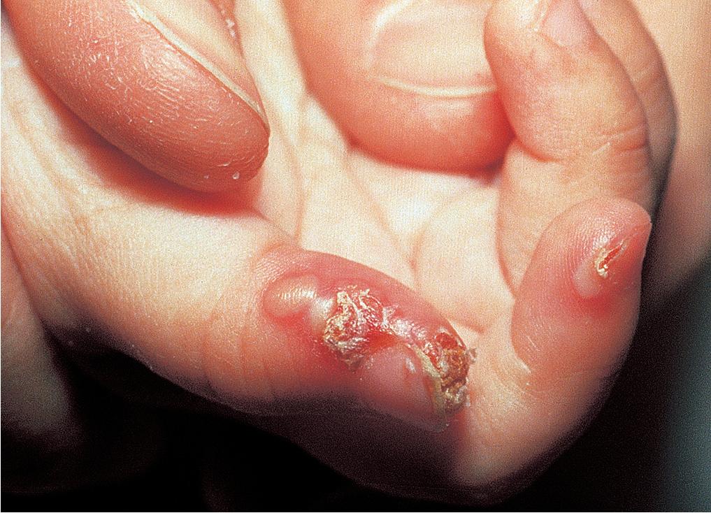 Fig. 4.6, Blistering distal dactylitis developed on the right thumb and index finger of a 5-year-old girl. Cultures from her throat and thumb grew Group A β-hemolytic streptococci. The infection responded quickly to oral amoxicillin.