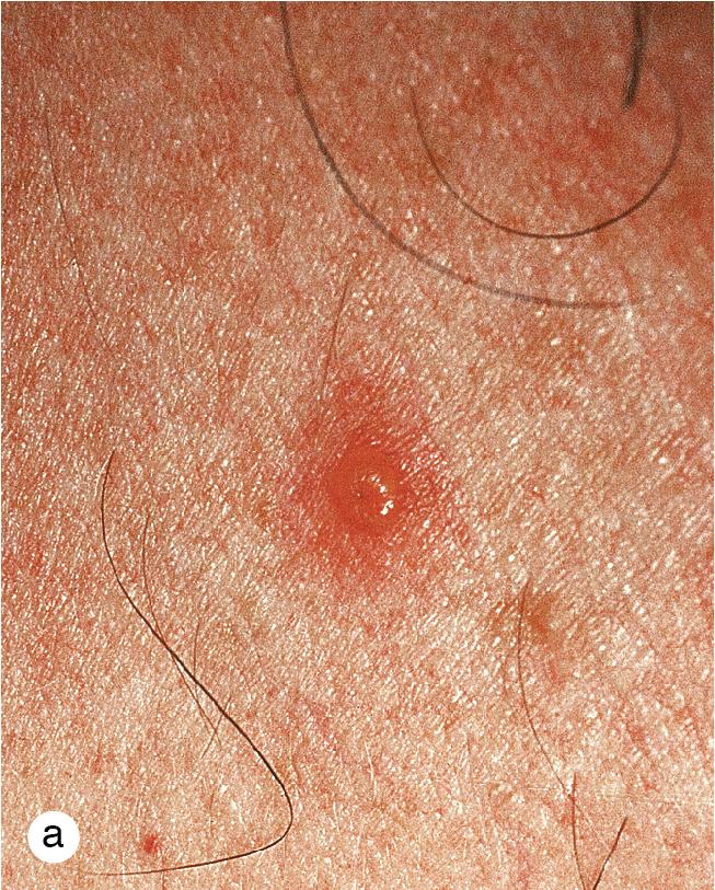 Fig. 4.7, Chickenpox. (a) A dew drop on a rose petal is the characteristic primary lesion in chickenpox. (b) Lesions in various stages of development, including red papules, vesicles, umbilicated vesicles, and crusts developed in close proximity on the forehead of a toddler with varicella. (c) Severe varicella with blisters almost to confluence erupted within 24 h over much of the skin surface of this 6-year-old boy who was on high-dose systemic corticosteroids for inflammatory bowel disease.