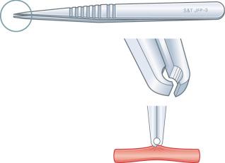 Figure 25.2, Pierse forceps with a minute hole in the tip, useful to hold adventitia.