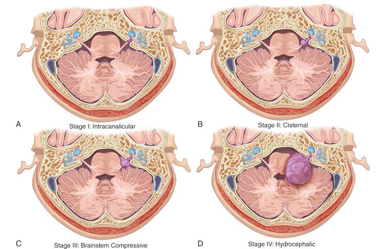 Figure 37.1, The four stages of the growth of the vestibular schwannomas according to their extension. (A) Stage I: intracanalicular; (B) Stage II: cisternal; (C) Stage III: brainstem compressive; (D) Stage IV: hydrocephalic.