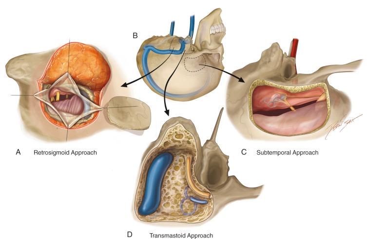 Figure 37.3, (A–D) The usual anatomic landmarks for the three surgical approaches to an acoustic neuroma: retrosigmoid/suboccipital, translabyrinthine and middle fossa.