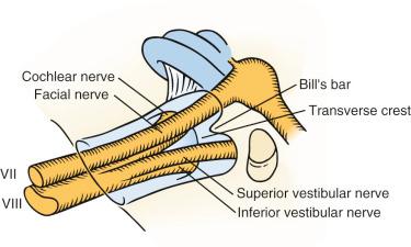 Figure 37.4, The internal acoustic canal showing Bill's bar, separating the facial nerve from the superior vestibular nerve; and the transverse crest, separating the facial nerve and superior vestibular nerve from the inferior vestibular nerve and the cochlear nerve.