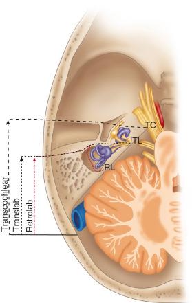 Figure 37.5, The retrolabyrinthine (RL) approach provides access to the presigmoid posterior fossa between the sigmoid sinus and the labyrinth. The translabyrinthine (TL) approach sacrifices the labyrinth to provide access to the internal auditory canal and cerebellopontine angle without cerebellar retraction. The transcochlear (TC) approach is an anterior extension of the translabyrinthine approach that sacrifices the entire inner ear and requires transposition of the facial nerve to provide access to the anterior cerebellopontine angle, petrous apex and ventral brainstem.