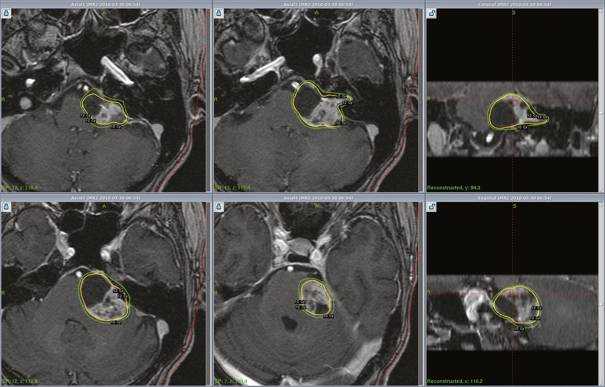 FIGURE. 94.1, MR images at Gamma Knife radiosurgery in an 84-year-old woman with a vestibular schwannoma. The dose plan is shown using the Perfexion Gamma Knife to a margin dose of 12 Gy.