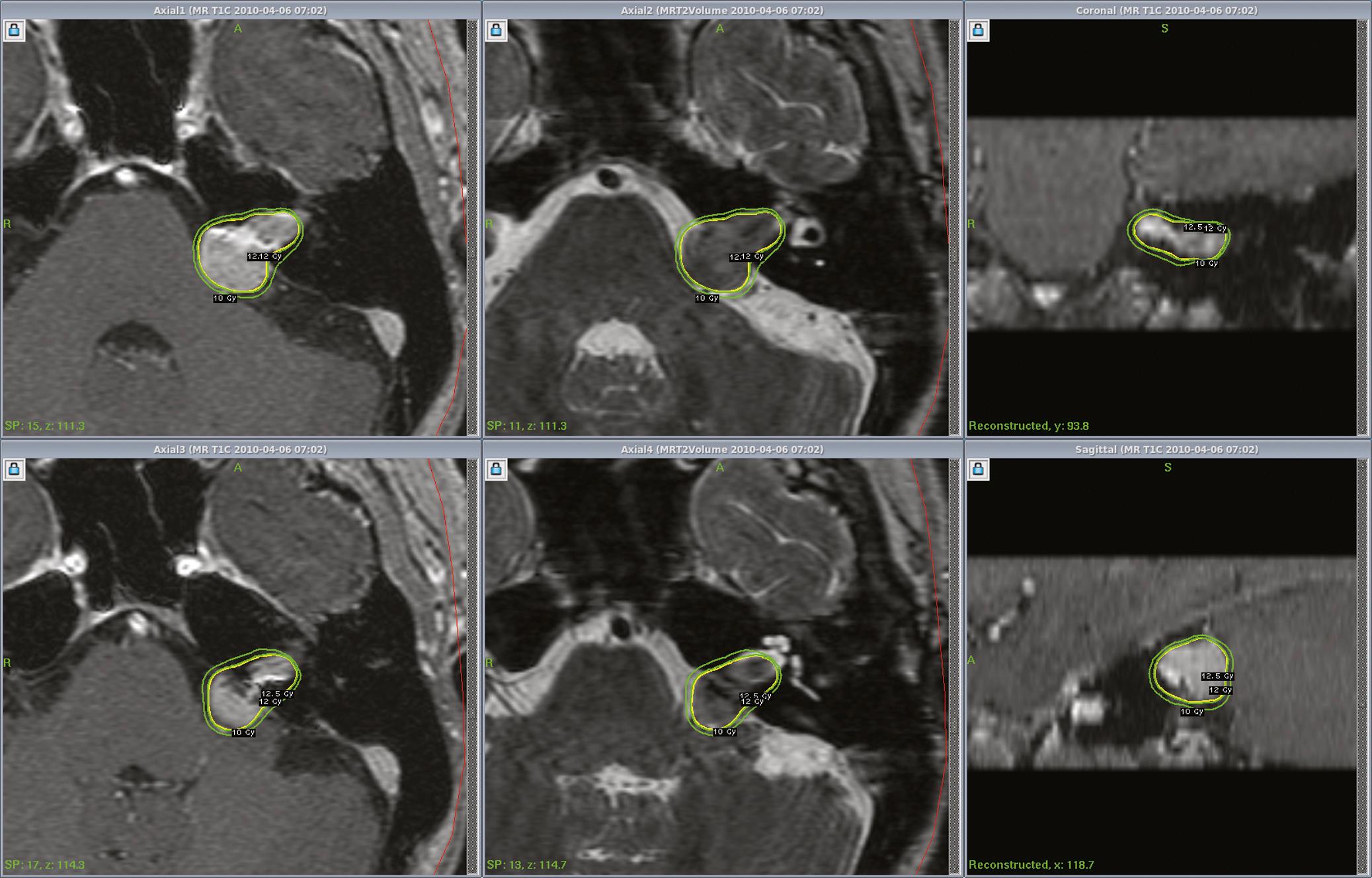 FIGURE. 94.2, MR images at Gamma Knife radiosurgery in an 80-year-old woman with a vestibular schwannoma. The dose plan is shown using the Perfexion Gamma Knife to a margin dose of 12.5 Gy.